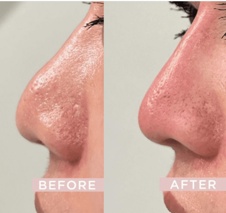 Điều trị biến chứng thông khe ngực sau khi nâng